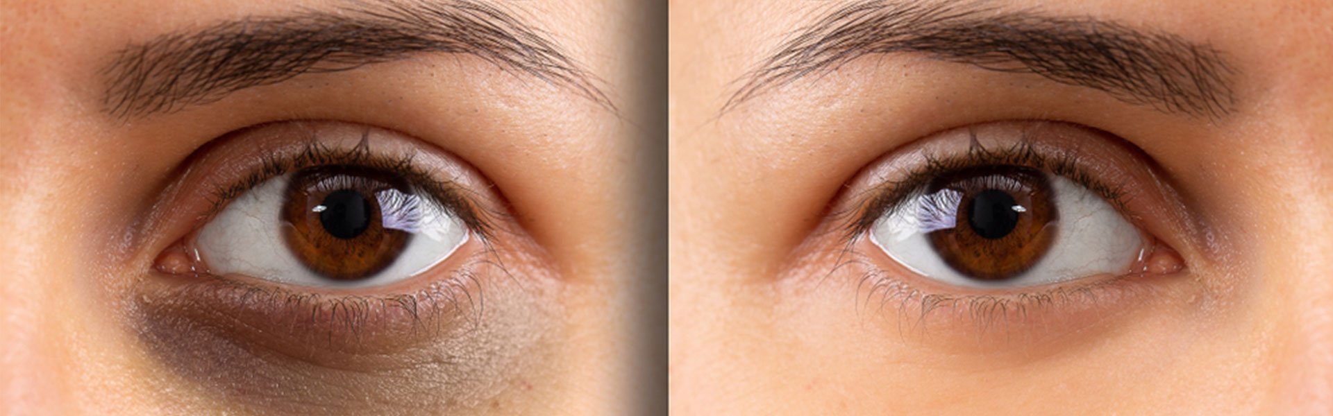 Två ögon bredvid varandra med den på vänster som har mörka ringar under ögat och den till höger som inte har det