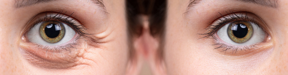 Två ögon bredvid varandra med den på vänster som har påsar under ögat och den till höger som inte har det